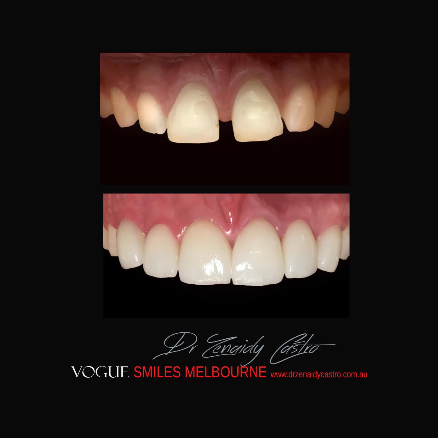 Porcelain-Veneers-in-Mlebourne-CBD-Before-and-After-gallery-5.jpg