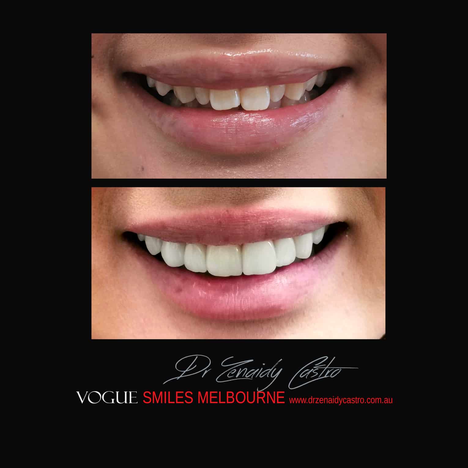 Porcelain-Veneers-in-Mlebourne-CBD-Before-and-After-gallery-6.jpg