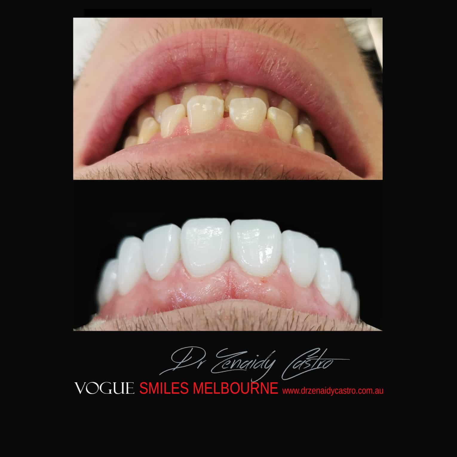 Porcelain-Veneers-in-Mlebourne-CBD-Before-and-After-gallery-7.jpg