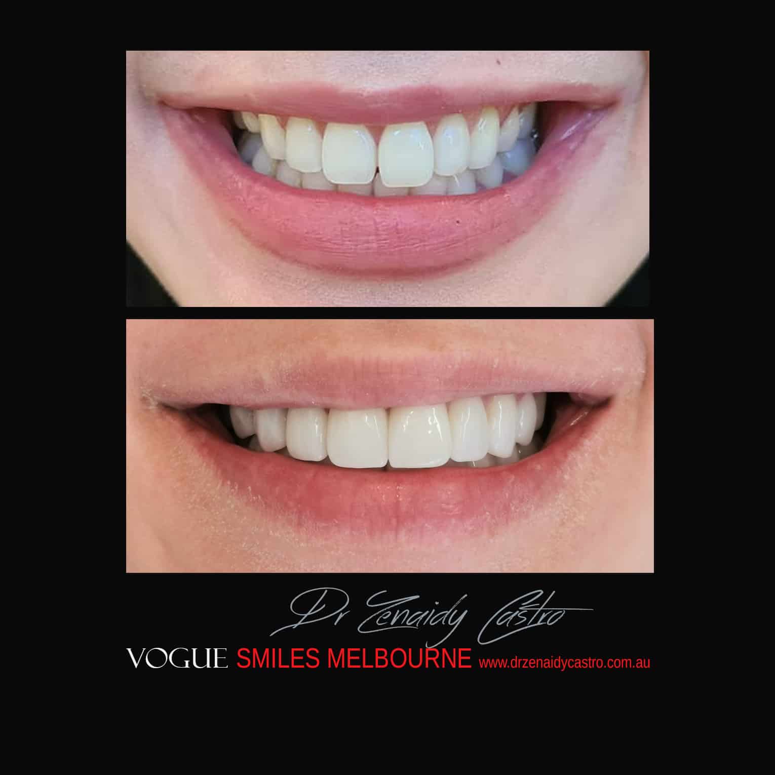 Porcelain-Veneers-in-Mlebourne-CBD-Before-and-After-gallery-8.jpg