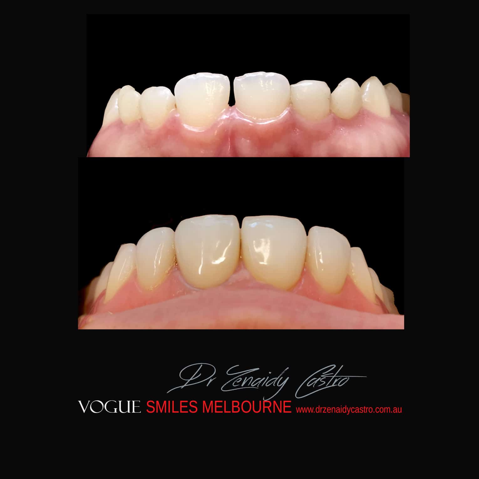 Porcelain-Veneers-in-Mlebourne-CBD-Before-and-After-gallery-9.jpg