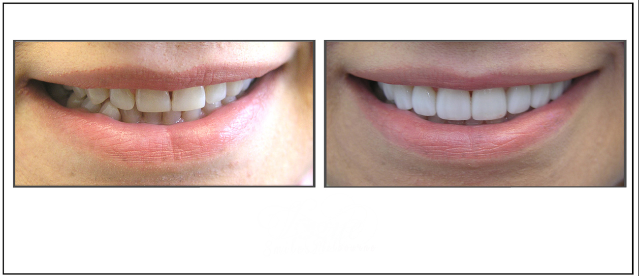 Porcelain Veneers Melbourne FAQ Vogue Smiles Melbourne