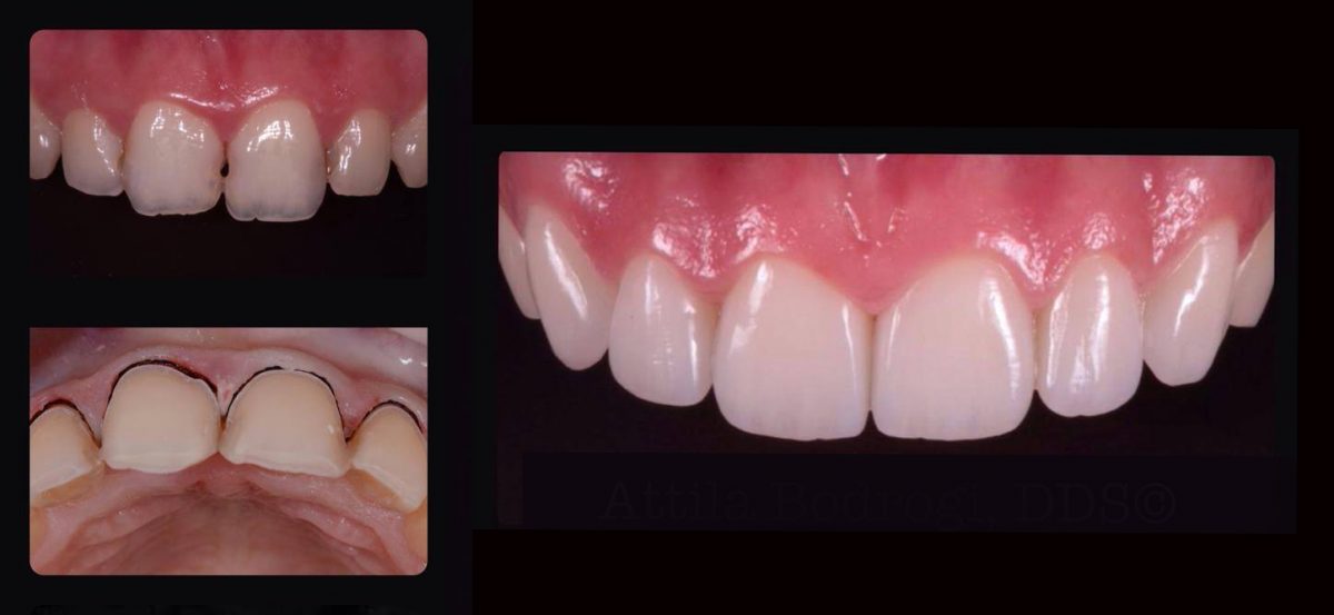 Porcelain Veneers Melbourne FAQ Vogue Smiles Melbourne