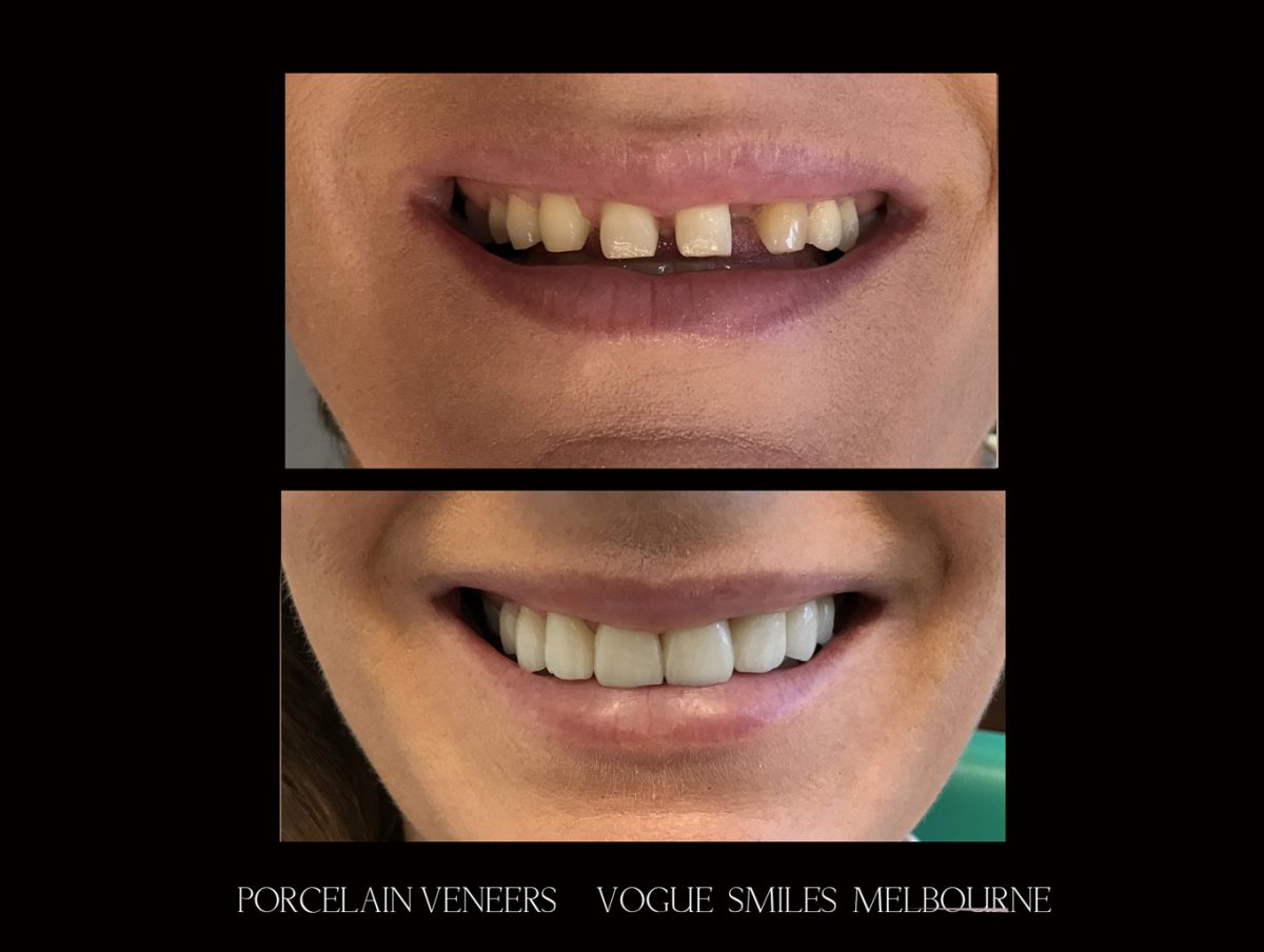 Porcelain Veneers Melbourne FAQ Vogue Smiles Melbourne