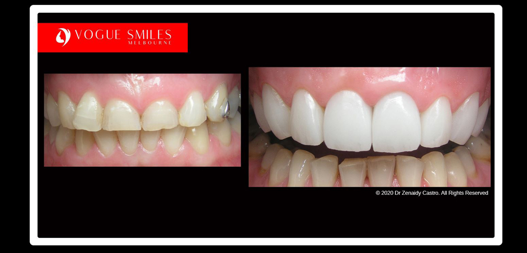 Porcelain Veneers Melbourne FAQ Vogue Smiles Melbourne