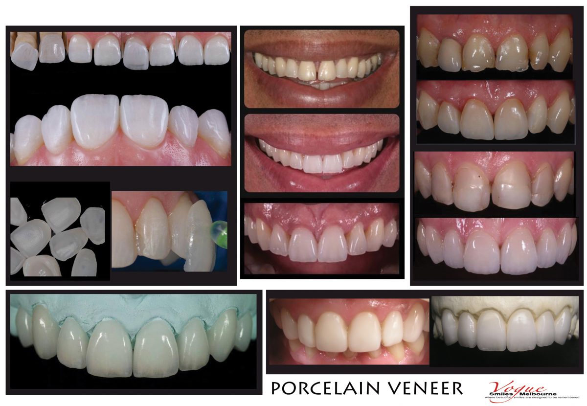 Porcelain Veneers Melbourne FAQ Vogue Smiles Melbourne