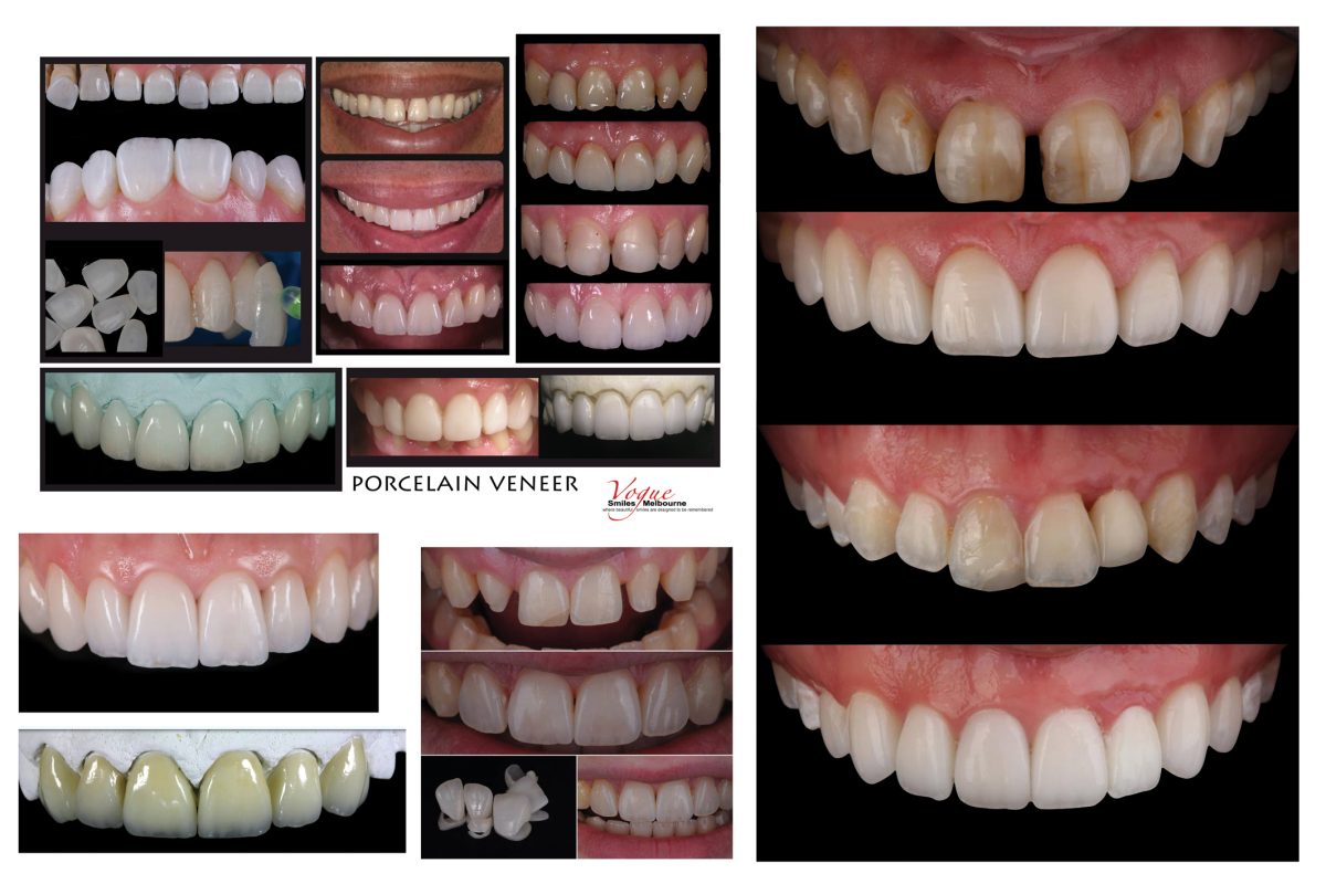 Porcelain Veneers Melbourne FAQ Vogue Smiles Melbourne